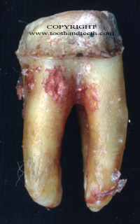 This tooth has been out for too long and has dehydrated, the top of the tooth is missing an artificial crown.
