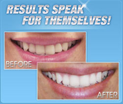 Teeth whitening results using Alta White