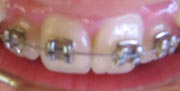 Braces-close-up-look