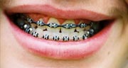 Both males and females, teenagers and adults, are opting to have braces