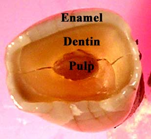 Teeth grinding causes the layers of the teeth to be worn away, and cracks to appear through out the tooth or teeth