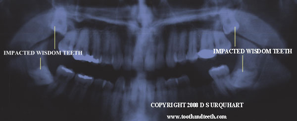Impacted wisdom teeth often require an operation to remove them, so as to save the other teeth next to them.