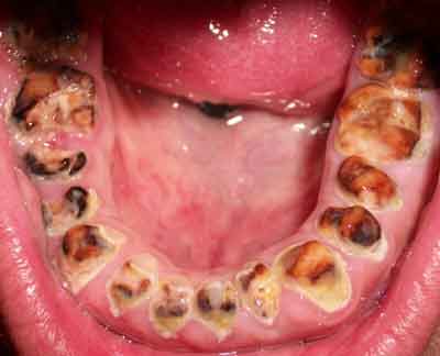 Bottom teeth with advanced tooth decay, often refferred to as meth teeth