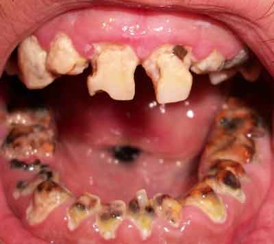 Teeth with advanced tooth decay aka meth teeth