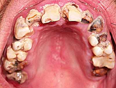 Top set of meth teeth - teeth with advanced tooth decay