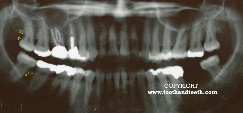Bone loss, as shown in this xray,  is a typical feature of gum disease / periodontal disease.
