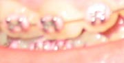 Braces don't have to look unattractive.