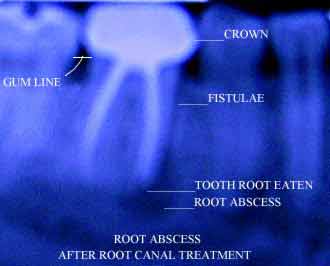 X-ray of tooth abscess following root canal treatment and crown