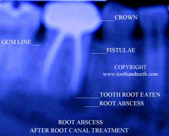 X-ray of tooth abscess following root canal treatment and crown