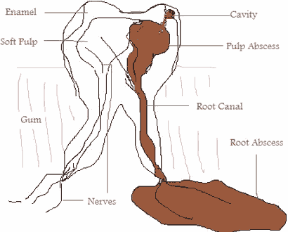 can augmentin treat toothache