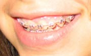 Braces for constant use to correct tooth and teeth alignment problems