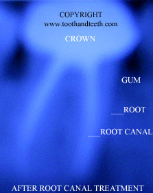 This is how a tooth looks under x-ray after root canal treatment