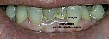 Plaque is one of the most destructive diseases of teeth.
